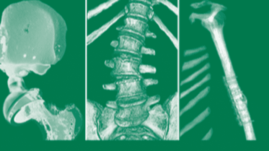 EUROPEAN CONGRESS ON ORTHOPAEDICS - EFORT